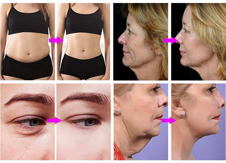 New Style 2 in 1 Focused RF & 3D Hifu Skin Lift Anti-aging Facial Lifting Anti Wrinkle Machine 12 lines