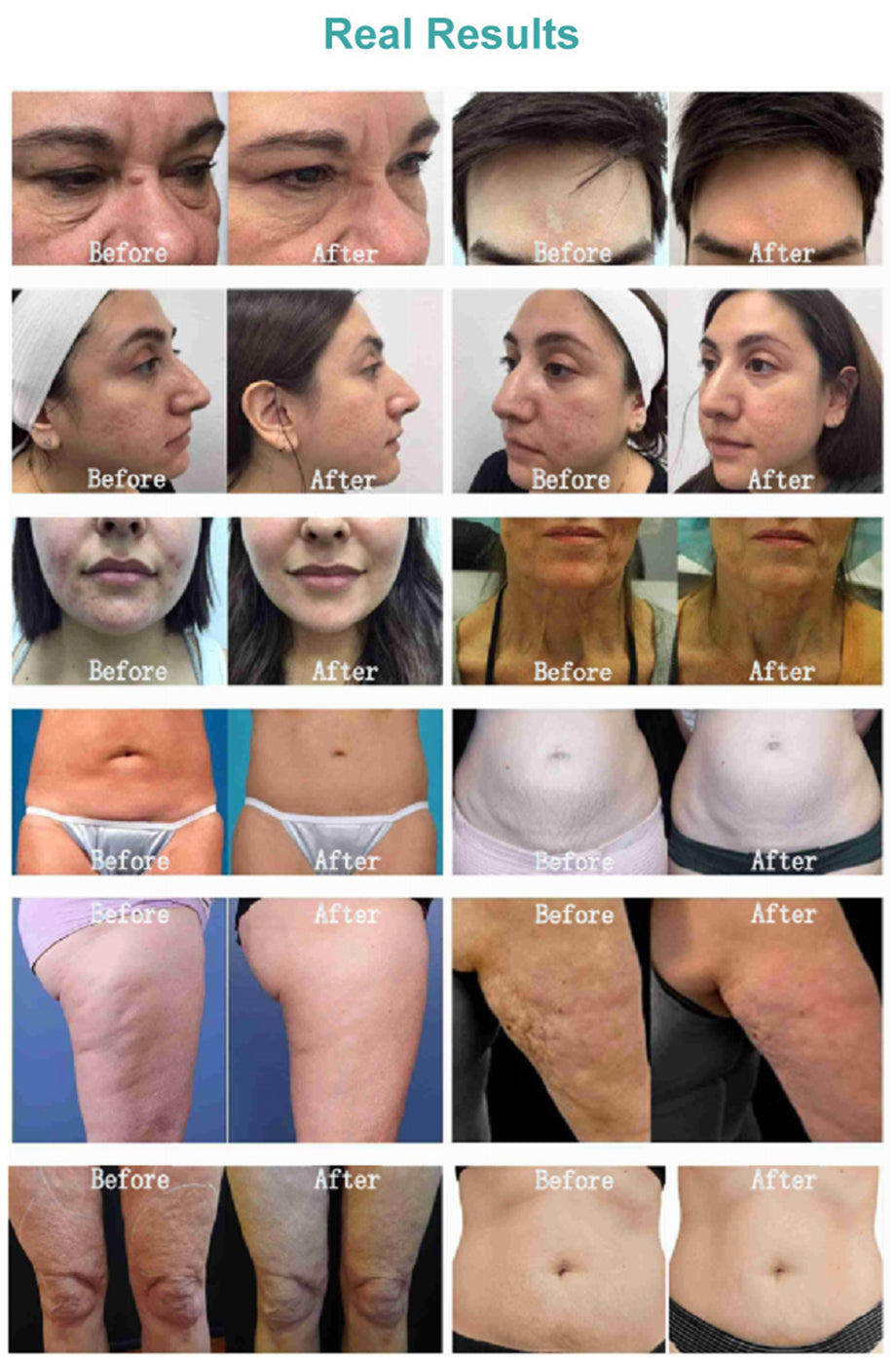 Morpheus 8 Fractional Machine High Radio Frequency Facial Machine Car Pigment Stretch Marks Small Pores Morpheus8 Machine