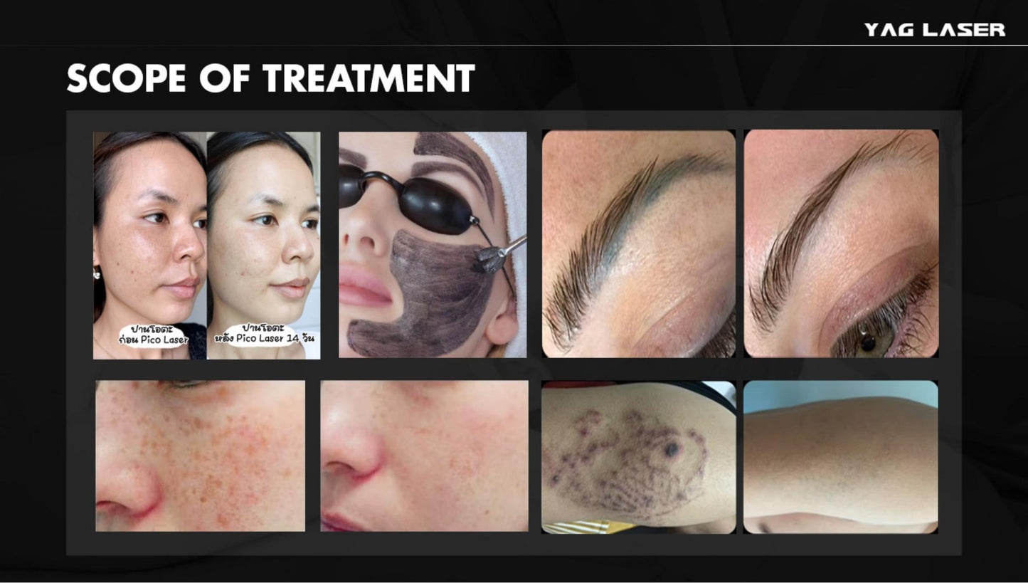 Carbon Peel Skin Whitening Q Switched Nd Yag Laser Tattoo Removal Pico Laser Machine